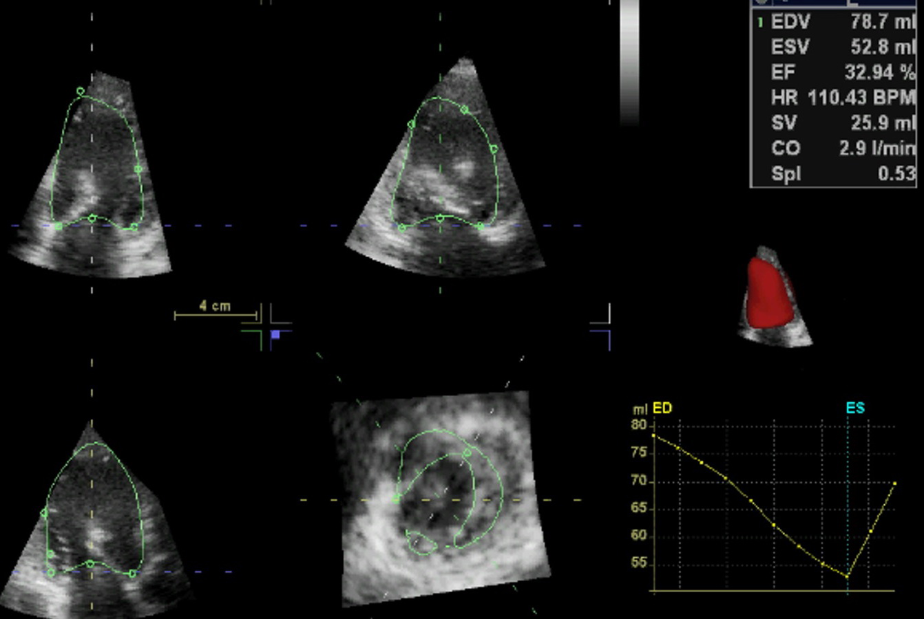 Cardiac ultrasound 3D-EF