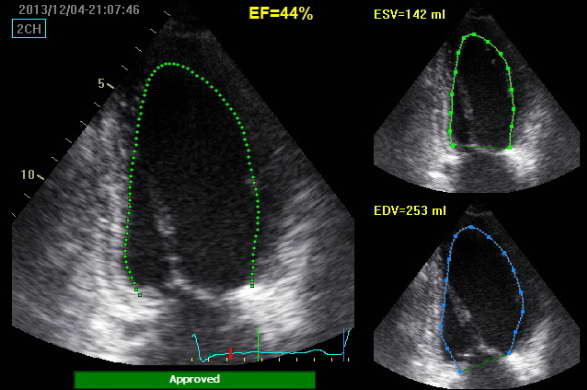 Cardiac ultrasound Auto-EF